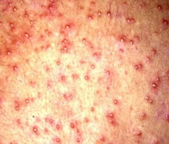 Miliaria Pustulosa