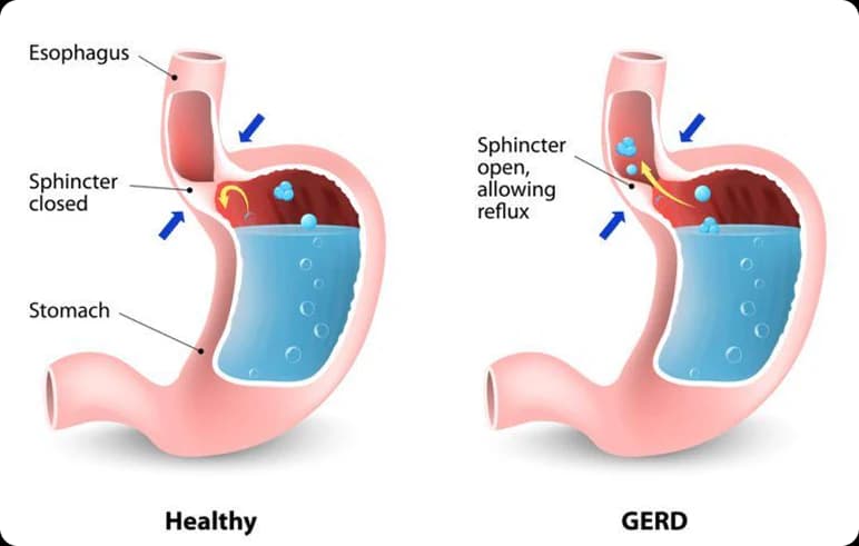 Acid reflux and gastro-oesophageal reflux disease
