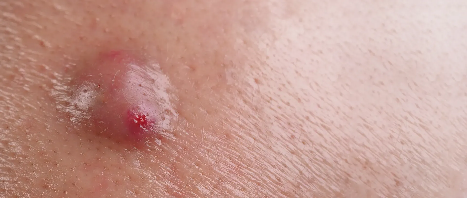 Cysts
