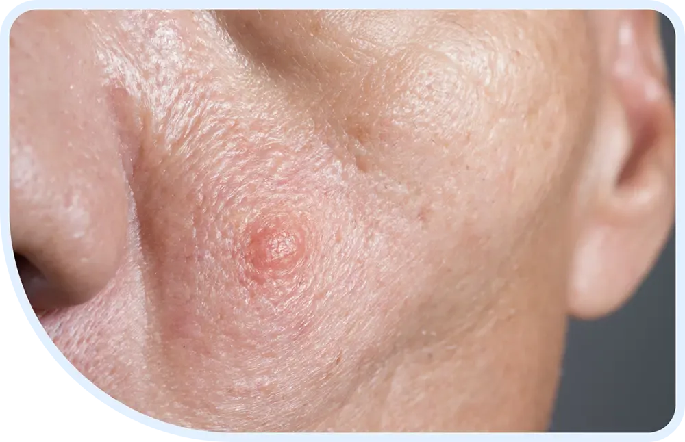 carcinoma-complications-1