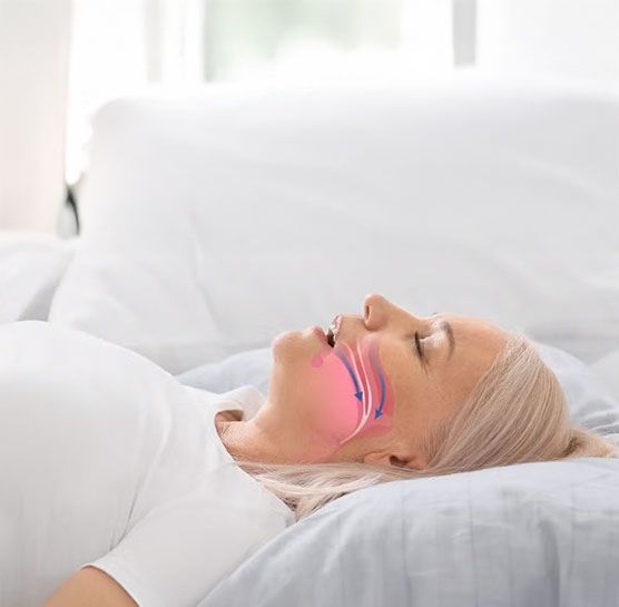 What Is Obstructive Sleep Apnoea and Why Does It Matter?