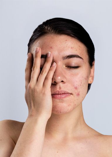 Acne and acne scarring