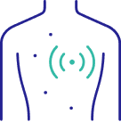 Melanoma