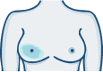 Localised thickening or a lump behind the nipple.