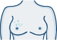 Rash, redness, or irritation on the nipple or surrounding skin.