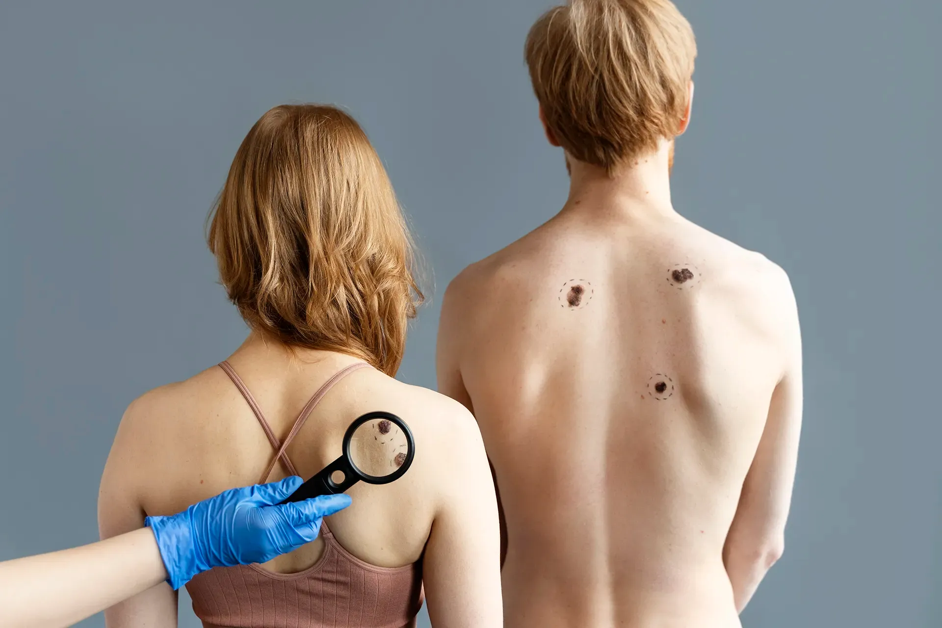 Skin Cancer