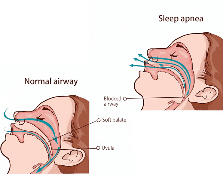 What causes Obstructive sleep apnoea?